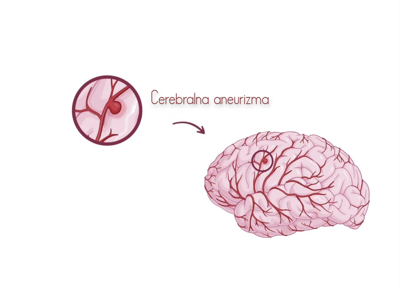 aneurizma